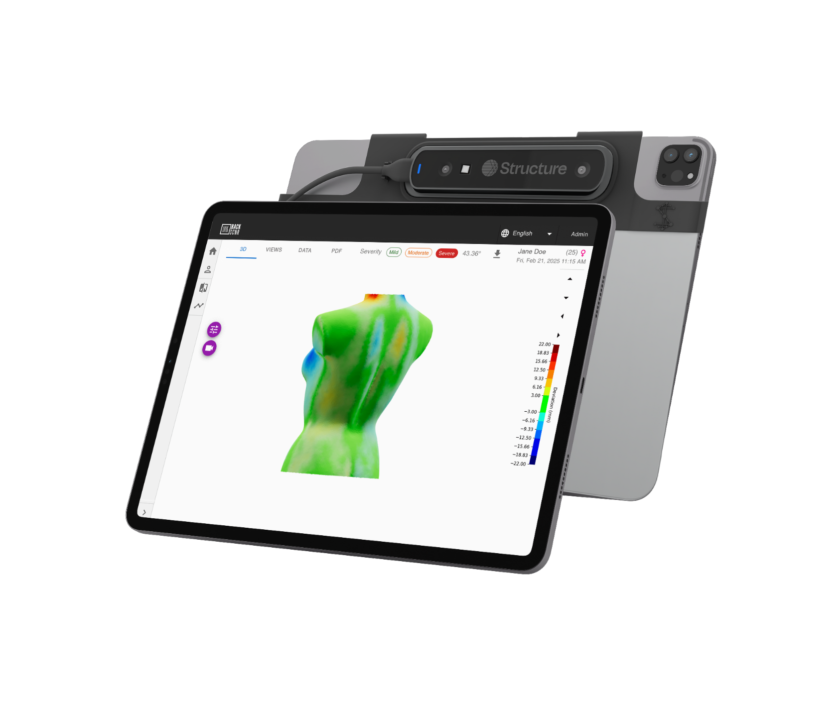 iPad with Structure Sensor for scoliosis assessment